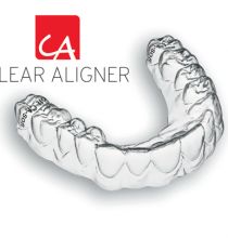 Quy trình niềng răng khớp cắn sâu