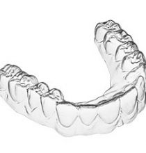 Răng khểnh có nên niềng răng bằng khay trong suốt ADClearAligner không?