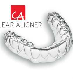 Niềng răng xong có bị hở lợi không?